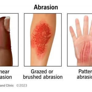 Abrasions