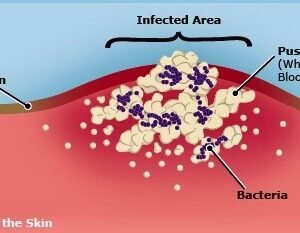 Abscess / Carbuncle / Boils