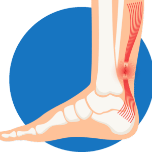 Achilles Tendon Injury (sports injuries)