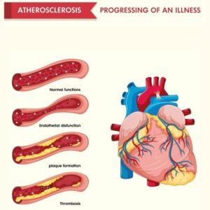 Arteriosclerosis
