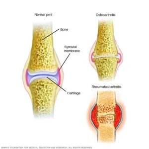 Arthritis, Osteo