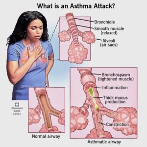 Asthma