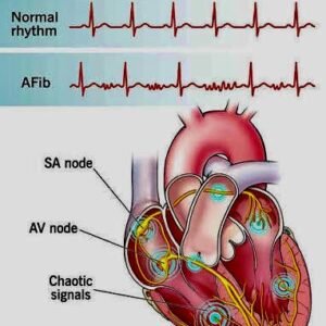 Atrial Fibrillation