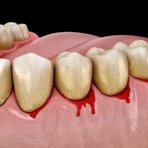 Bleeding Gums