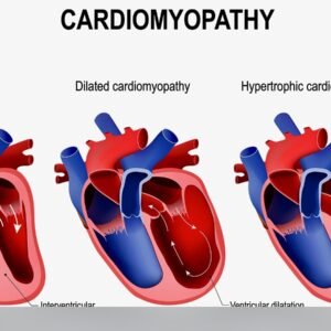 Cardiomyopathy