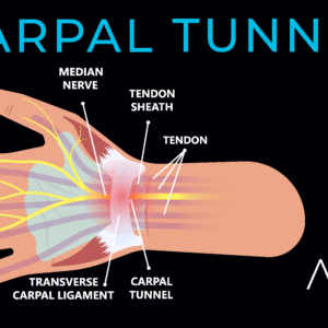 Carpal Tunnel Syndrome