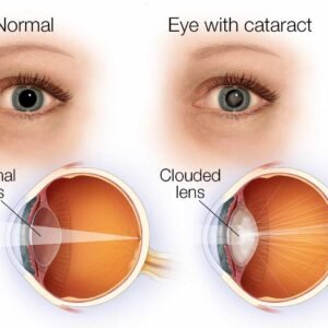Cataracts
