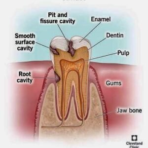 Cavities ( dental cavities)