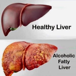 Cirrhosis of the Liver