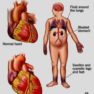 Congestive Heart Failure