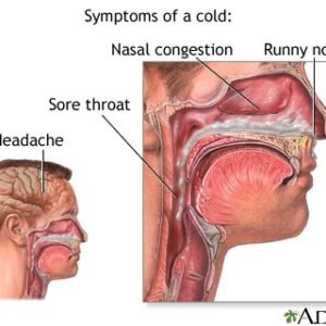 The common cold